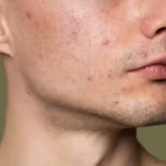 Pimples treatment in men