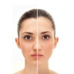 Before and After of a Glowing skin treatments