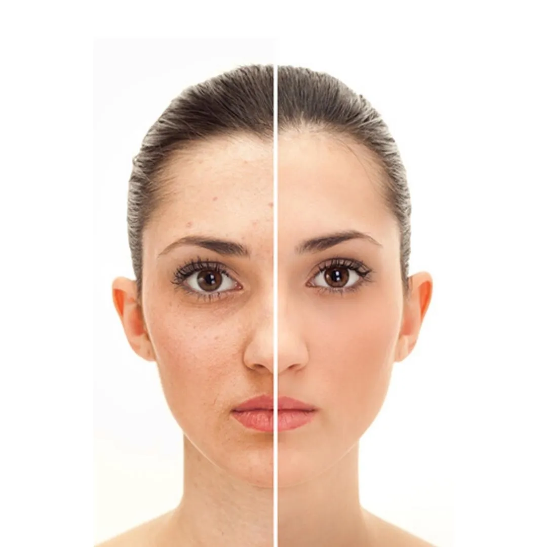 Before and After of a Glowing skin treatments