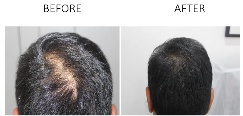 GFC Hair Regrowth Of a men
