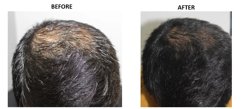 GFC Hair Regrowth in kokapet