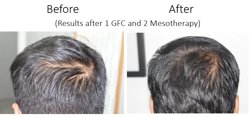 GFC Hair Regrowth and Meso in kokapet