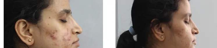 Before and after Peel For Active Acne and Acne Scars