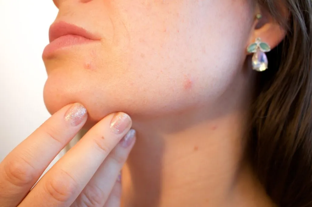 acne treatment for a women