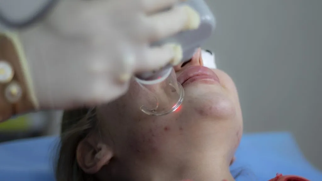 Acne and Scar Treatment in Kokapet Hyderabad