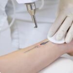 tattoo removal treatment