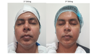 Forma-for-Skin-Tightening-1.png
