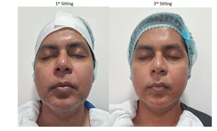 Forma-for-Skin-Tightening-1.png