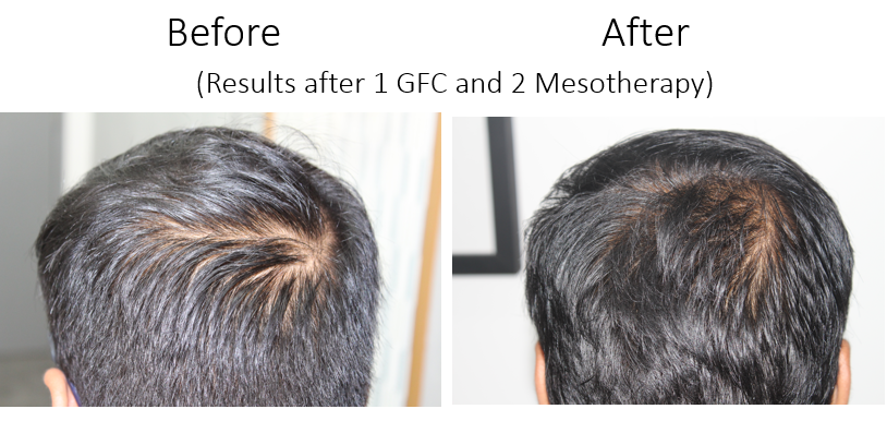 GFC-for-Hair-regrowth-and-Meso-for-Hair-growth-1-session.png