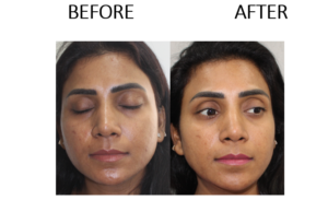 IV-Glutathion-Drips-for-Skin-Lightening-10-sessions.png
