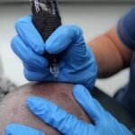 Scalp Micropigmentation