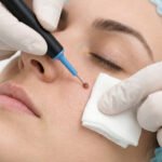 Cauterization