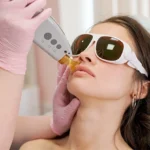 q-switch laser treatment