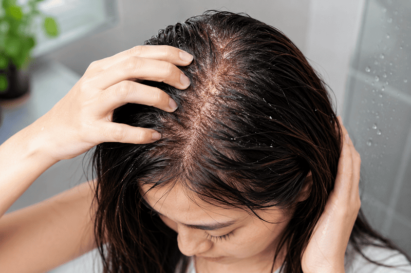 monsoon scalp infections symptoms