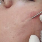 subcision treatment for acne scar treatment