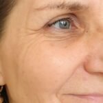 Fine lines and wrinkles