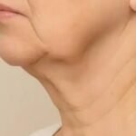 Loose Neck Skin