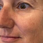 Mild to moderate skin sagging