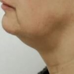 Sagging jawline or jowls