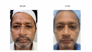 Skin Treatment Before and After 6