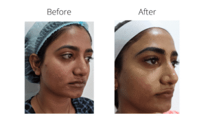 Skin Treatment Before and After 5