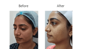 Skin Treatment Before and After 4