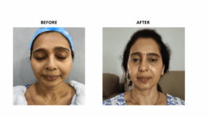 Skin Treatment Before and After 3