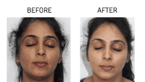 Skin Treatment Before and After 2