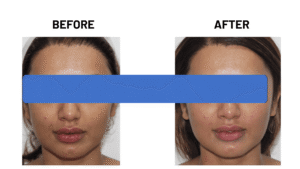 Skin Treatment Before and After 1