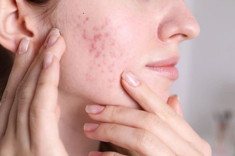 Acne Treatment