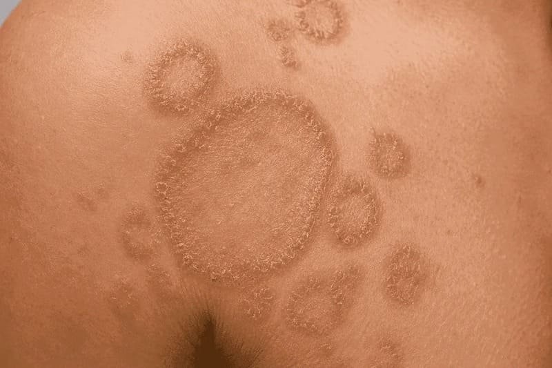 Skin Infection Treatment