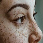 Freckles