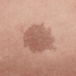 Pigmented lesions