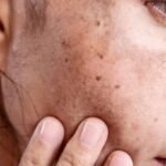 age spots