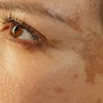 uneven skin tone